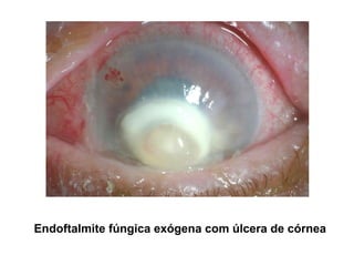 Endoftalmite fúngica exógena com úlcera de córnea
 