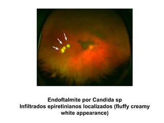 Endoftalmite por Candida sp
Infiltrados epiretinianos localizados (fluffy creamy
white appearance)
 