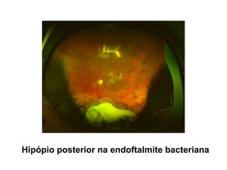 Hipópio posterior na endoftalmite bacteriana
 