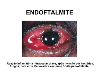 ENDOFTALMITE
Reação inflamatória intraocular grave, após invasão por bactérias,
fungos, parasitos. Se invade a esclera e órbita-pan-oftalmite.
 