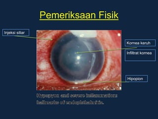 Pemeriksaan Fisik
Injeksi siliar
Kornea keruh
Infiltrat kornea
Hipopion
 
