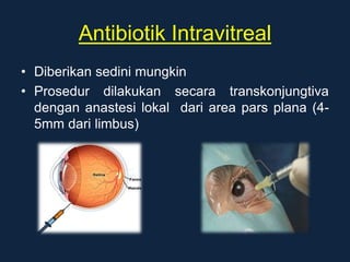 Antibiotik Intravitreal
• Diberikan sedini mungkin
• Prosedur dilakukan secara transkonjungtiva
dengan anastesi lokal dari area pars plana (4-
5mm dari limbus)
 