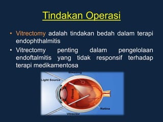 Tindakan Operasi
• Vitrectomy adalah tindakan bedah dalam terapi
endophthalmitis
• Vitrectomy penting dalam pengelolaan
endoftalmitis yang tidak responsif terhadap
terapi medikamentosa
 