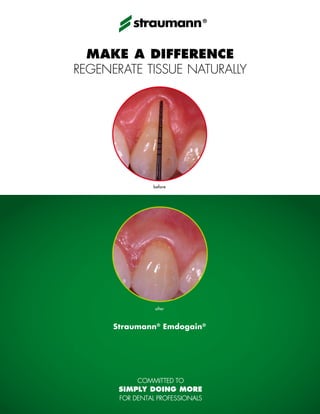 ®




  Make a difference
regenerate tissue naturally




              before




               after



      Straumann® Emdogain®
 