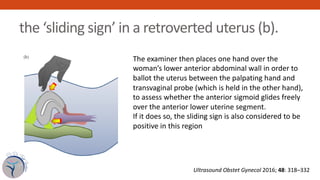the ‘sliding sign’ in a retroverted uterus (b).
321
(b)
he ‘sliding sign’ in an anteverted uterus (a) and a retroverted ut...
