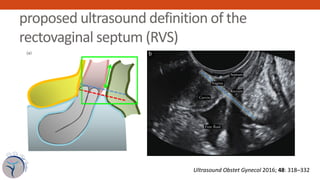 proposed ultrasound definition of the
rectovaginal septum (RVS)
IDEA consensus opinion 323
Septum
Rectum
Vagina
Cervix
(a)...