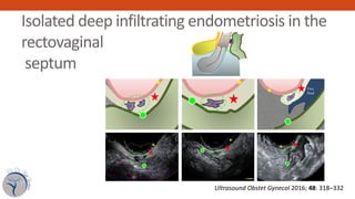 Isolated deep infiltrating endometriosis in the
rectovaginal
septum
posterior lip of the cervix. The posterior vaginal for...