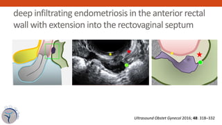 deep infiltrating endometriosis in the anterior rectal
wall with extension into the rectovaginal septum
Figure 6 Schematic...