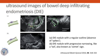ultrasound images of bowel deep infiltrating
endometriosis (DIE)consensus opinion 325
(a)
Transverse
section
Bowel
Uterus
...