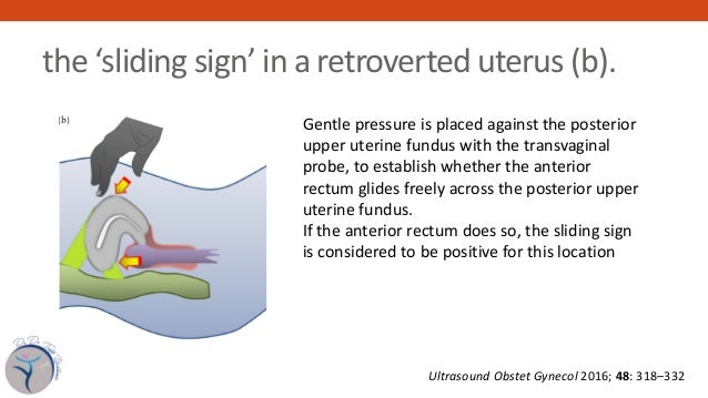 Imaging For The Diagnosis Of Endometriosis Imaging For The Diagnosis Of Endometriosis