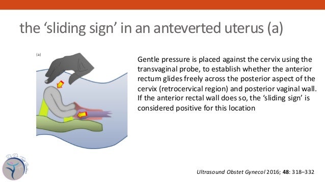 Imaging For The Diagnosis Of Endometriosis Imaging For The Diagnosis Of Endometriosis