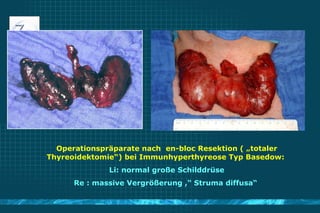 Operationspräparate nach  en-bloc Resektion ( „totaler Thyreoidektomie“) bei Immunhyperthyreose Typ Basedow:  Li: normal g...