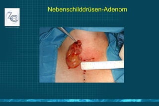 Nebenschilddrüsen-Adenom 