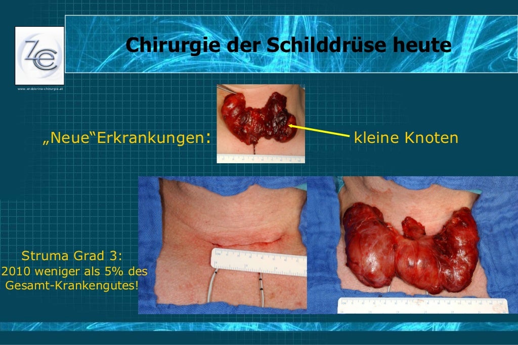 Endokrinchirurgie Update