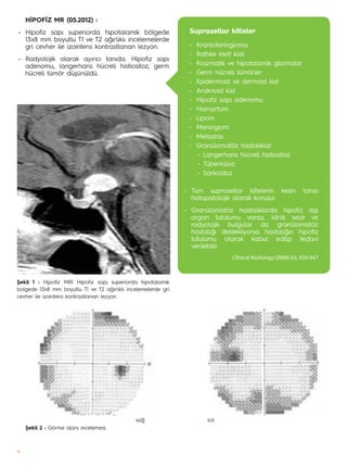 18
HİPOFİZ MR (05.2012) :
• Hipofiz sapı superiorda hipotalamik bölgede
13x8 mm boyutlu T1 ve T2 ağırlıklı incelemelerde
g...