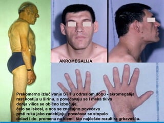AKROMEGALIJA
Prekomerno izlučivanje STH u odraslom dobu - akromegalija
rast kostiju u širinu, a povećavaju se i meka tkiva
donja vilica se obično izbočuje,
čelo se iskosi, a nos se značajno povećava
prsti ruku jako zadebljaju, povećava se stopalo
dolazi i do promena na kicmi, što najčešće rezultira grbavošću.
 