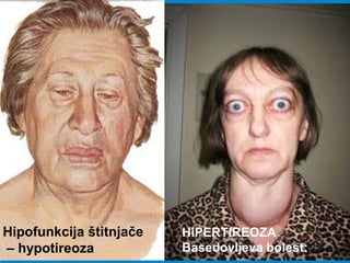 -
štitnjača je povećana i nastaje guša
povećan je bazalni metabolizam →
dolazi do gubitka težine
usprkos dobrom apetitu
pojačano znojenje i ubrzan puls
emocionalna labilnost i razdražljivost
često egzoftalmus (izbuljene oči)
HiPERTIREOZA
Basedovljeva bolest:
Hipofunkcija štitnjače
– hypotireoza
 