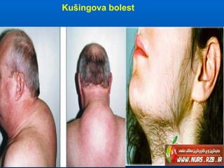 Kušingova bolest
Adenom nadbubrega, CT nalaz
 