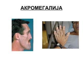 АКРОМЕГАЛИЈА
 