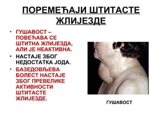 ПОРЕМЕЋАЈИ ШТИТАСТЕ
ЖЛИЈЕЗДЕ
• ГУШАВОСТ –
ПОВЕЋАВА СЕ
ШТИТНА ЖЛИЈЕЗДА,
АЛИ ЈЕ НЕАКТИВНА.
• НАСТАЈЕ ЗБОГ
НЕДОСТАТКА ЈОДА.
• БАЗЕДОВЉЕВА
БОЛЕСТ НАСТАЈЕ
ЗБОГ ПРЕВЕЛИКЕ
АКТИВНОСТИ
ШТИТАСТЕ
ЖЛИЈЕЗДЕ.
ГУШАВОСТ
 