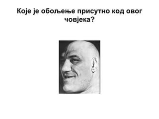 Које је обољење присутно код овог
човјека?
 