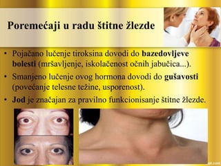 Poremećaji u radu štitne žlezde
• Pojačano lučenje tiroksina dovodi do bazedovljeve
bolesti (mršavljenje, iskolačenost očnih jabučica...).
• Smanjeno lučenje ovog hormona dovodi do gušavosti
(povećanje telesne težine, usporenost).
• Jod je značajan za pravilno funkcionisanje štitne žlezde.
 