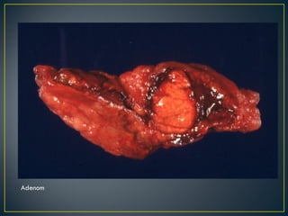 Adenom 