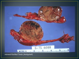 Adrenal Kortikal Tümör (Malignite?) 