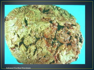 Adrenal Kortikal Karsinom 