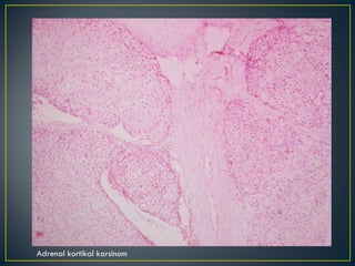 Adrenal kortikal karsinom 