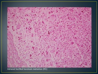 Adrenal kortikal karsinom metastazı (KC) 