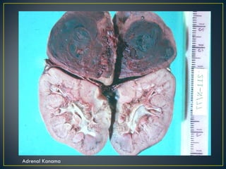 Adrenal Kanama 