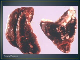 Adrenal Kanama 