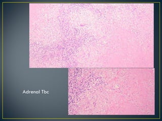 Adrenal Tbc 