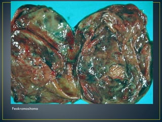 Feokromositoma 