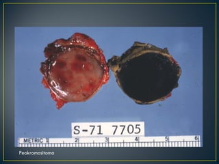 Feokromositoma 
