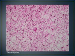 Feokromositoma 