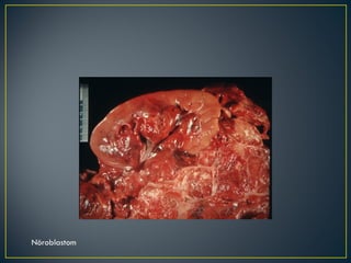 Nöroblastom 
