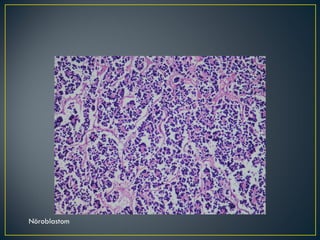Nöroblastom 