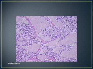 Nöroblastom 