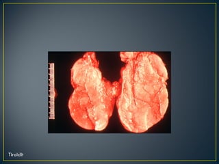 Tiroidit 