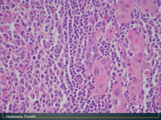 Hashimoto Tiroiditi 