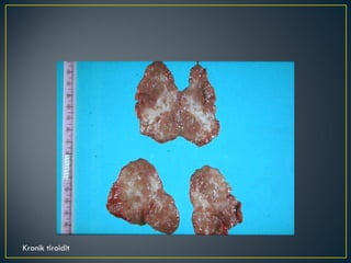 Kronik tiroidit 