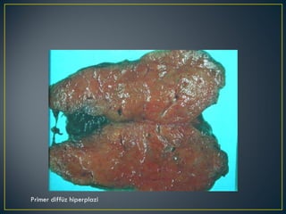 Primer diffüz hiperplazi 