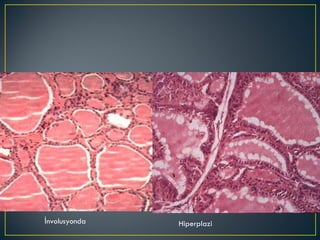 İnvolusyonda Hiperplazi 