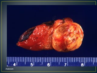 Adenom 