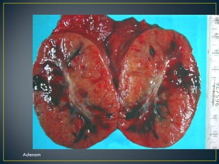 Adenom 