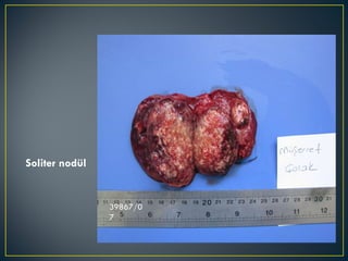 39867/07 Soliter nodül 