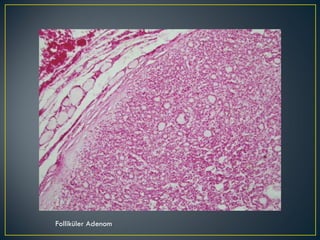 Folliküler Adenom 