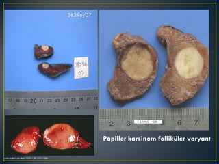 Papiller karsinom folliküler varyant Arch pathol Lab Med 2005 129:1575-1584 38296/07 